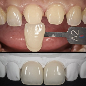 коронка бузмуталева кераміка