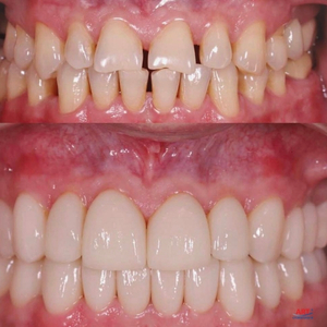 безметалеві коронки на зубах до та після